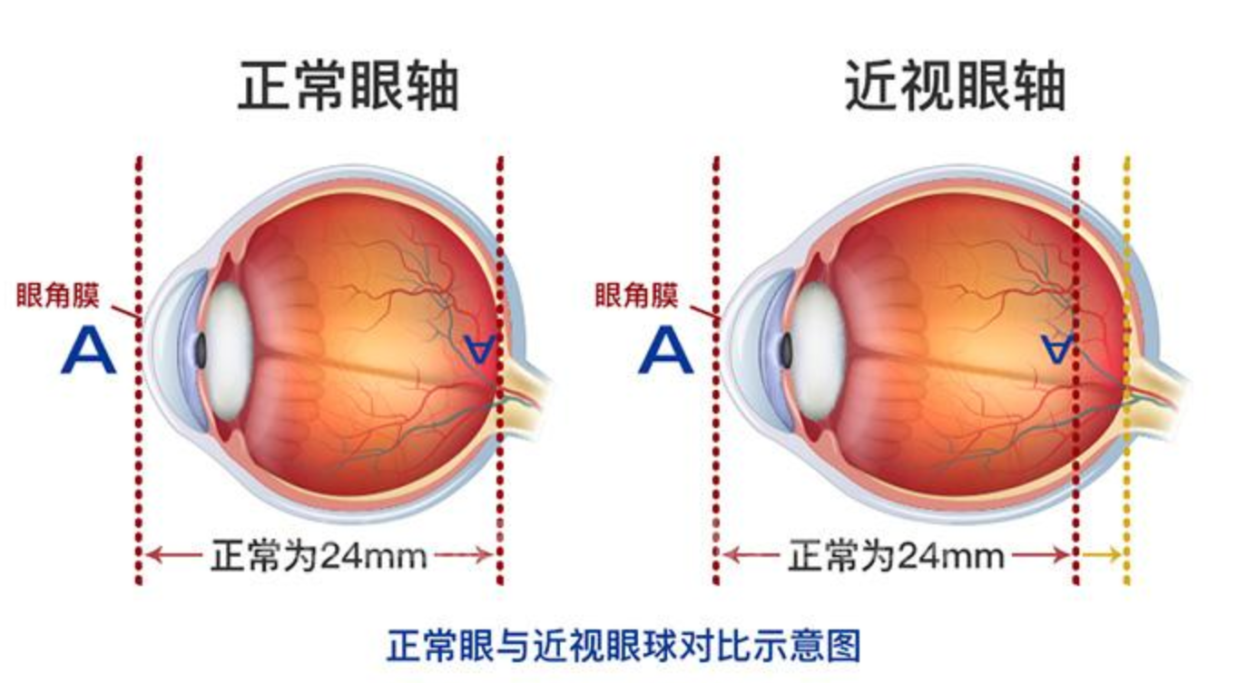 为什么有人近视眼球会特别凸出两位近视患者用亲身实验告诉你