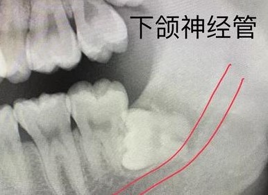 拔除前要拍曲面断层或ct片确定智齿的位置以及下牙槽神经的位置,因为