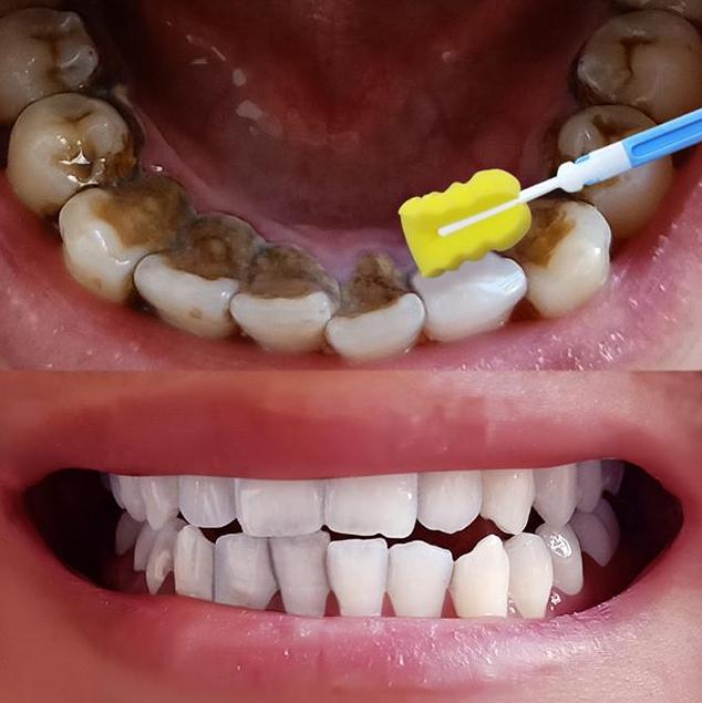 牙医透露:牙黄牙臭根本不用洗!用一常见小物,牙齿雪白
