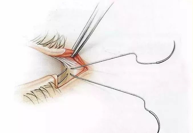 眼部专题|外眦的解剖结构与外眦开大术