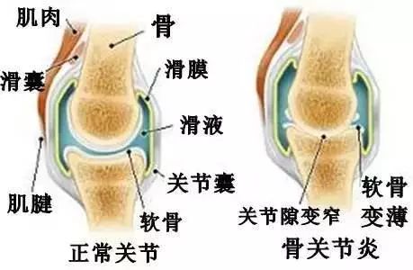 4个秘诀帮助骨关节炎患者熬过寒冬