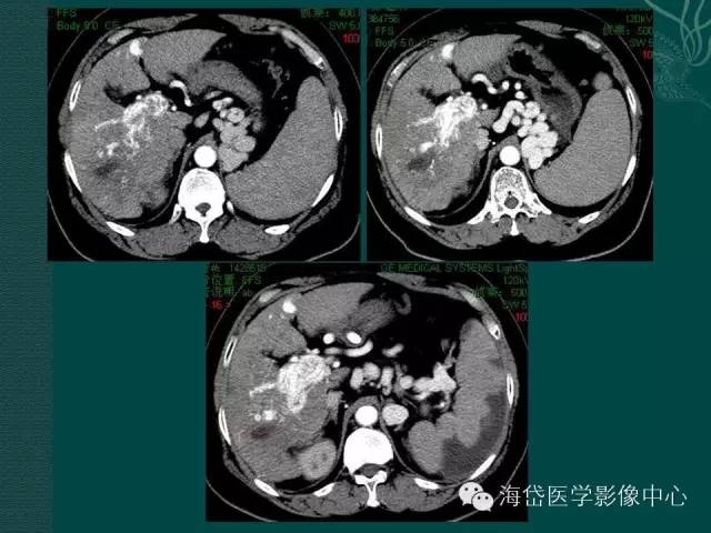 推荐ctpv门静脉海绵样变性