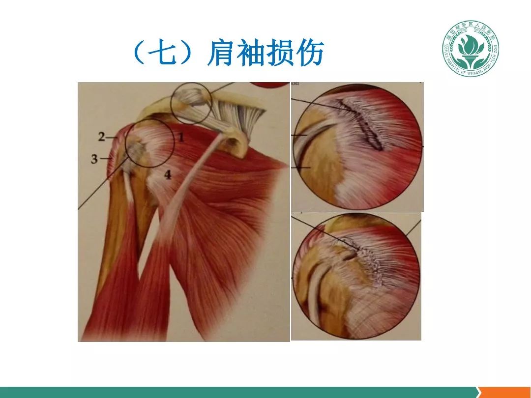 肩关节软组织压痛点的解剖与临床