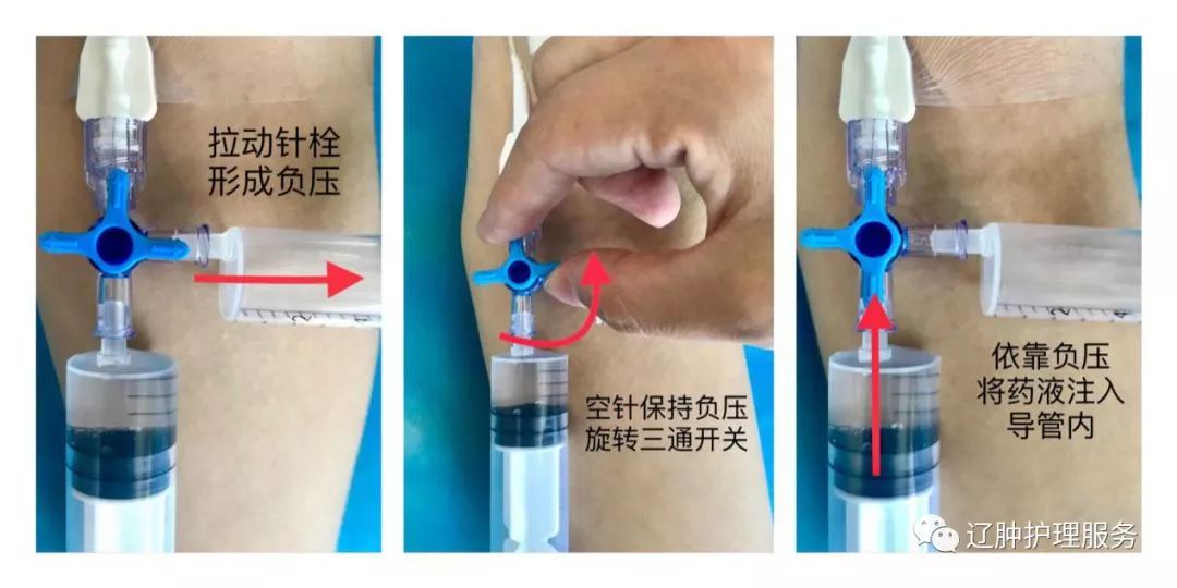 辽肿推文 | picc导管发生堵塞的处理方法