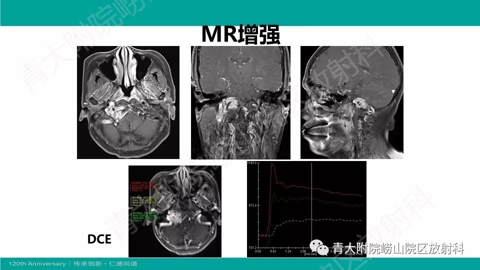 每日一例739例女右侧舌肌萎缩1月余