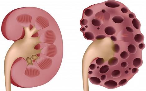 先天性多囊肾怎么办