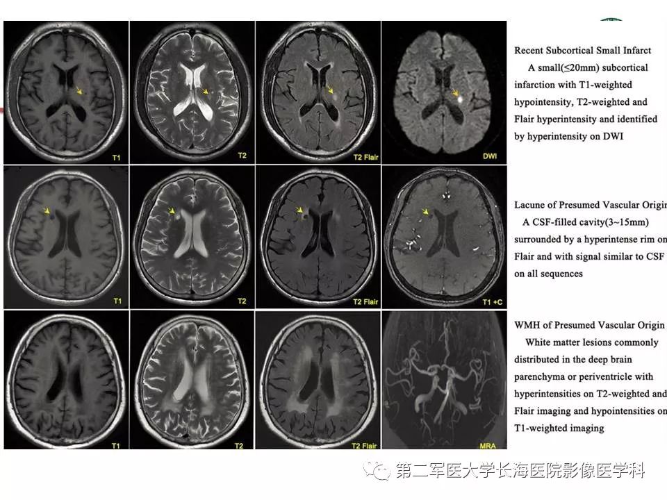 推荐| 脑小血管病的影像学基本征象与新进展