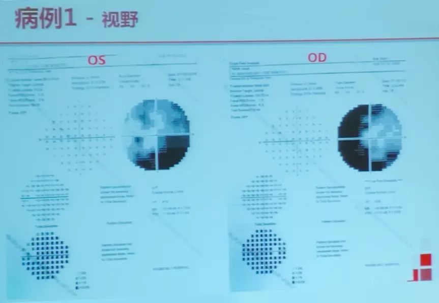 【惟视讲堂】忽大忽小的杯盘比——小小案例窥见青光眼本质