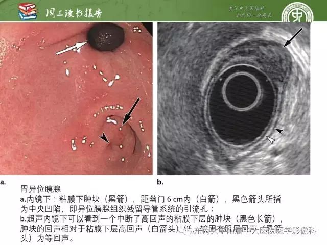 异位胰腺组织病理学影像学特征及并发症