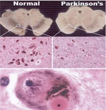 的中脑黑质体形态的比较[4(normal:正常;parkinson's:帕金森病;lewy