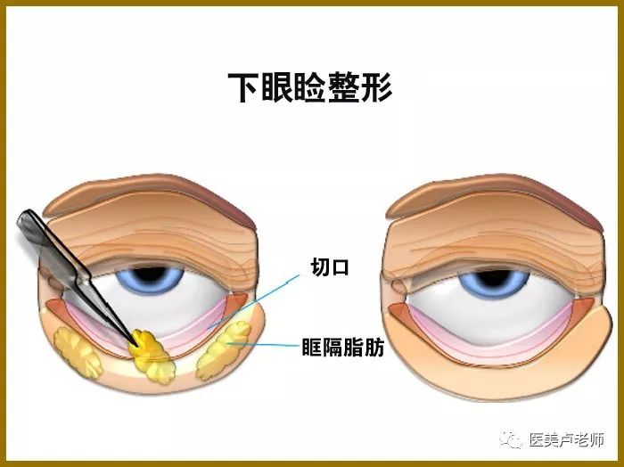 中央和外侧的脂肪间隔也由盘之间的间隔以及来自lockwood韧带筋膜扩张