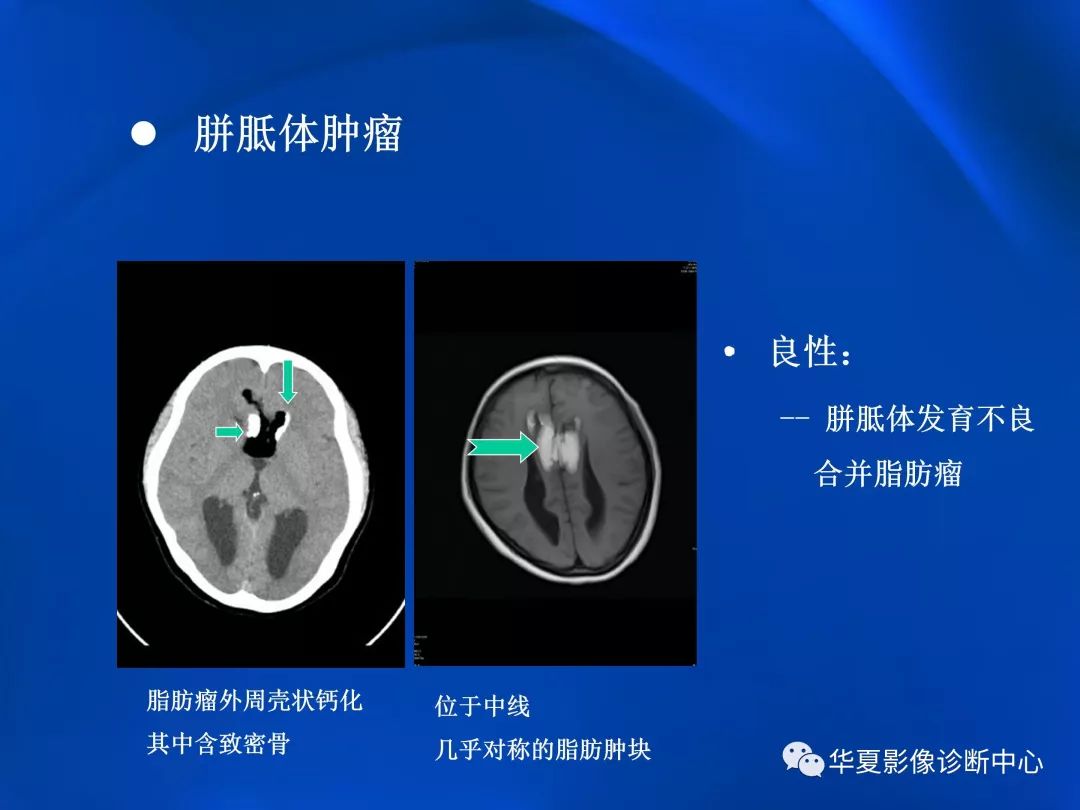 胼胝体病变影像学表现二