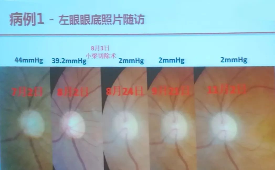 惟视讲堂忽大忽小的杯盘比小小案例窥见青光眼本质