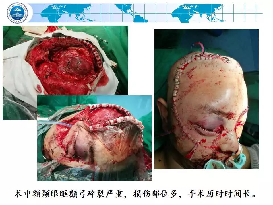 陈荣彬 精彩点评 投射物所致颅脑损伤,是开放性颅脑损伤普遍而特殊的