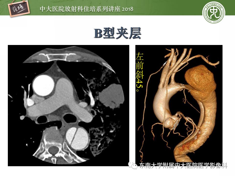 【中大放射住培讲座39】急性主动脉综合征的cta诊断与