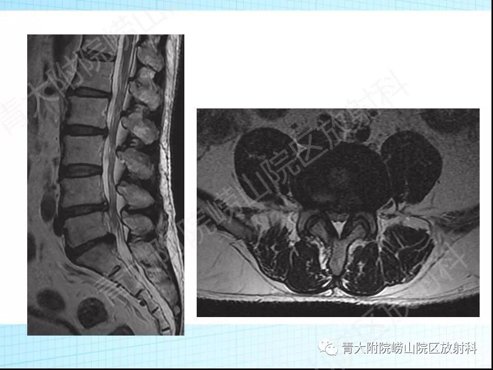 若干未受重视的腰椎管狭窄的mri表征