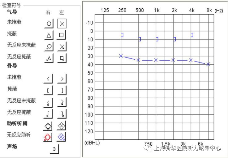 若骨,气导差值小于10dbhl,且都在正常范围以外,此为感音神经性听力