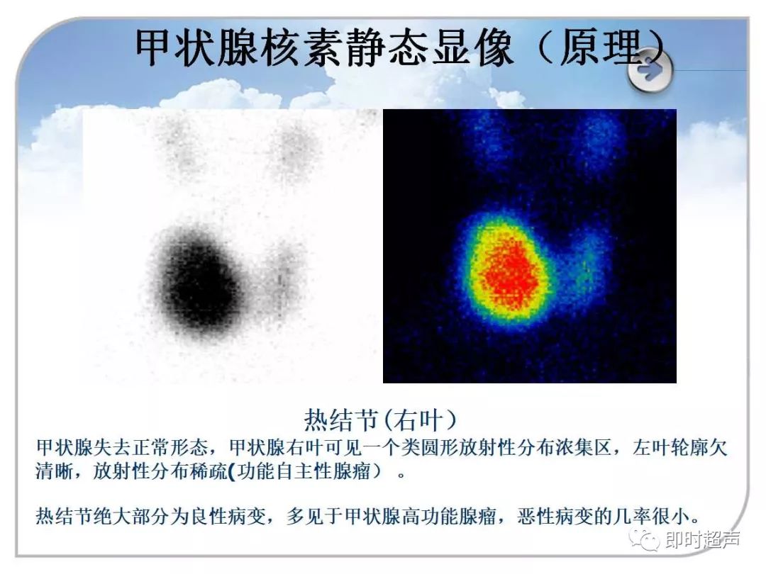 超声与核素显像对甲状腺的诊断应用