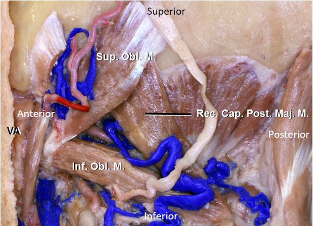 相关解剖颈静脉孔下斜坡枕骨大孔上颈段,延髓 (腹侧,外侧)椎动脉和
