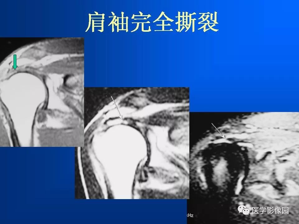 肩袖损伤mri诊断 | 影像天地