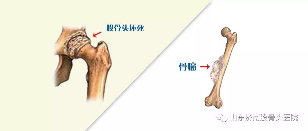 股骨头坏死是骨癌吗?