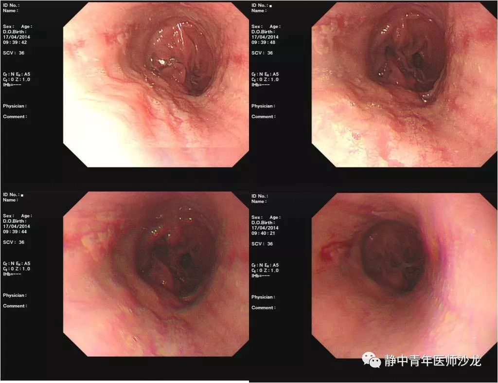 【原创】全胃切除后反流性食管炎一例