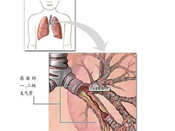 支气管炎需要向保险么 支气管炎可以做保险吗