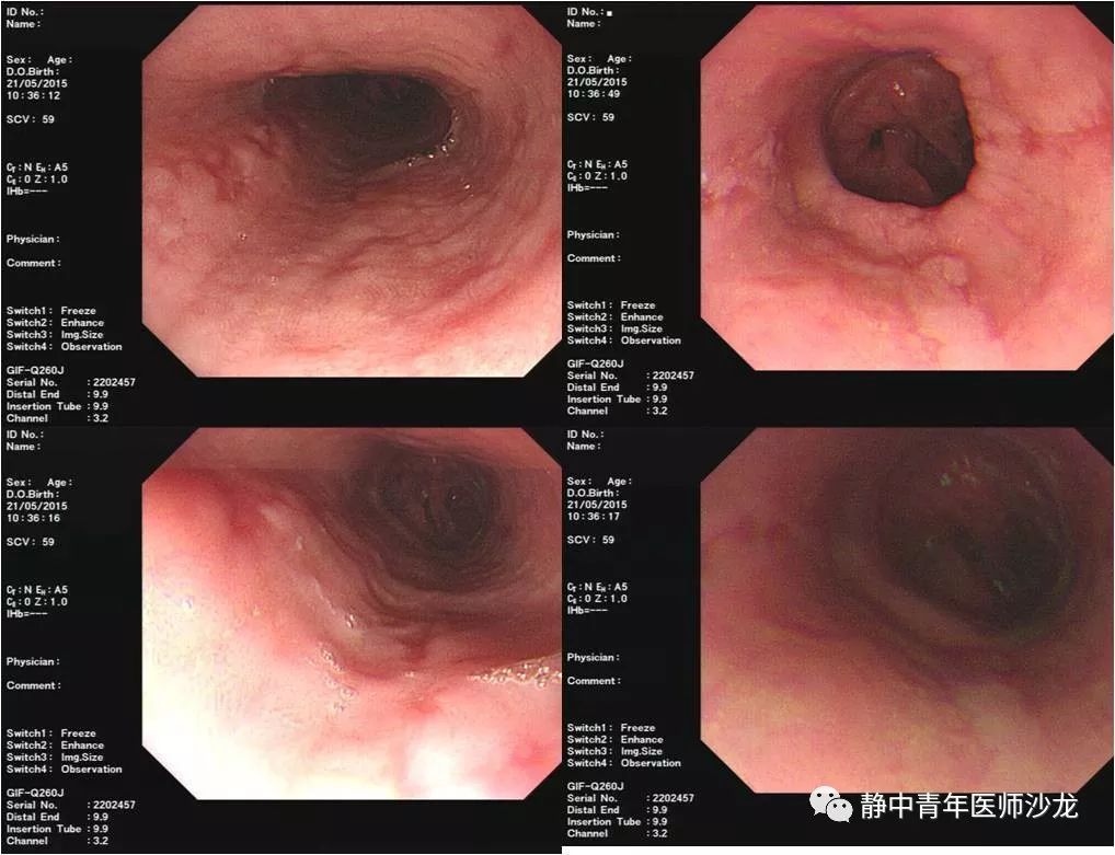 2015年5月12日胃镜诊断:反流性食管炎(b-c级) 吻合口炎.