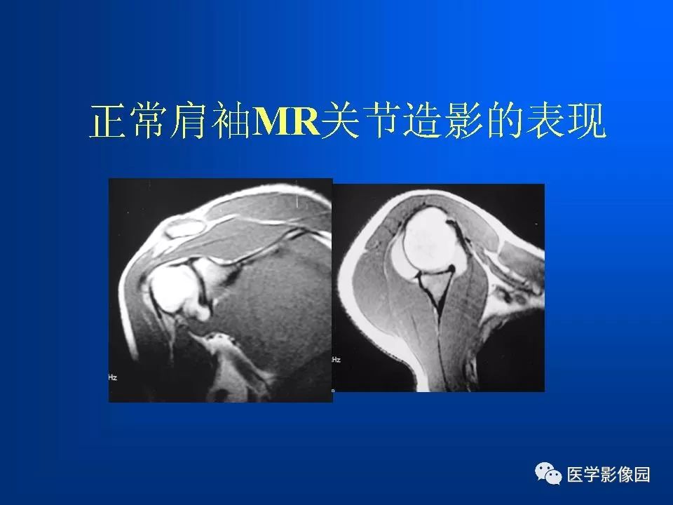 肩袖损伤mri诊断 | 影像天地