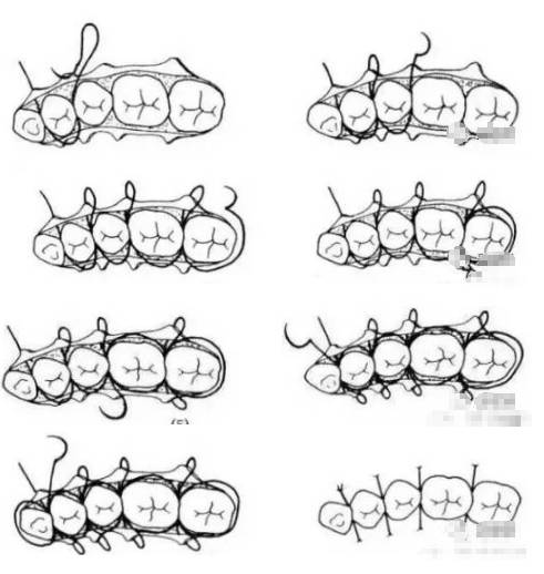 值得收藏牙医基本技能口内缝合术文字示意图及视频