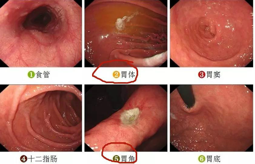 比如一开始我们示范看报告顺序的图,你一定要好好重视你的胃体,胃角