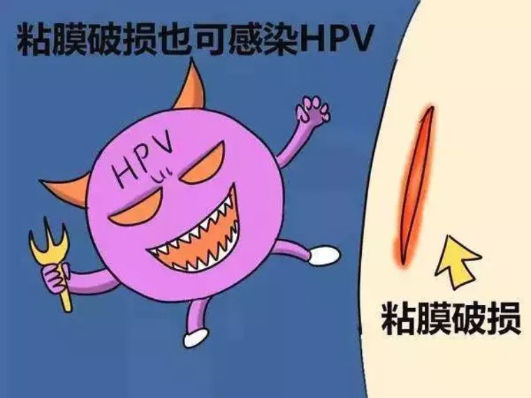 宫颈癌筛查tct和hpv该选择哪个?