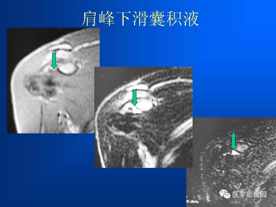 肩袖损伤mri诊断 | 影像天地
