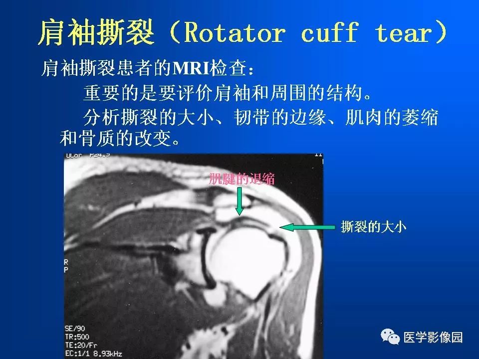 肩袖损伤mri诊断 | 影像天地