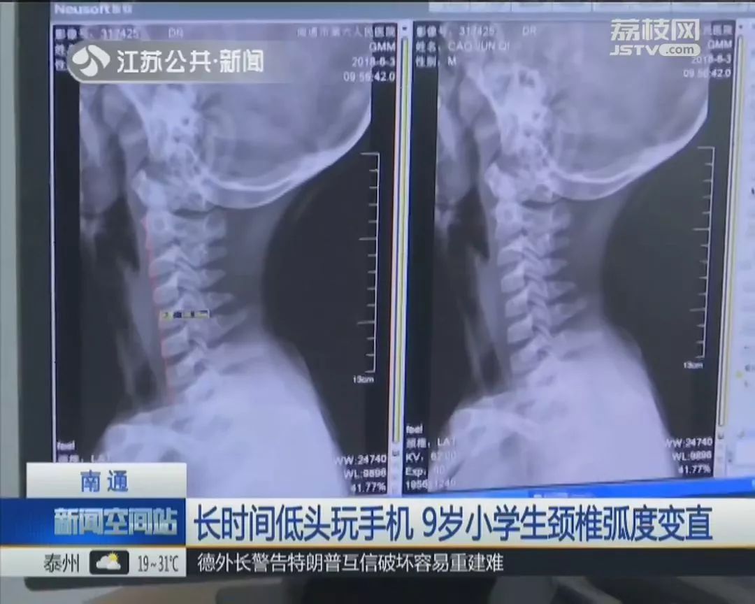 颈椎病人口_颈椎病的症状图片(2)