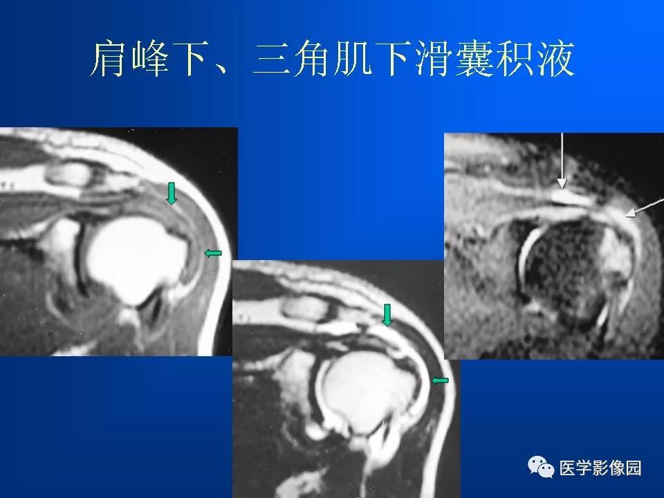 肩袖损伤mri诊断 | 影像天地