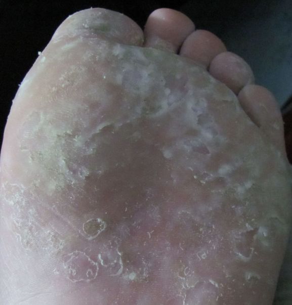 糜烂型脚气很容易继发细菌感染,引起脓疱,溃烂,还有万人烦的臭味.