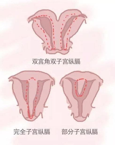 妇女更容易患不孕症,常见的子宫畸形有鞍状子宫,子宫纵膈,双角子宫等