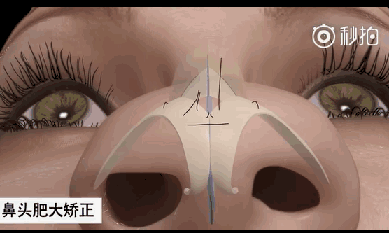 隆鼻手术过程全程动图演示，其实还没万圣节恐怖。宝美医疗美容