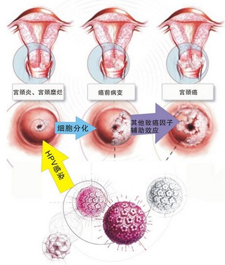 年轻女性宫颈糜烂经久不治,或是更年期后仍有宫颈糜烂,应该引起重视