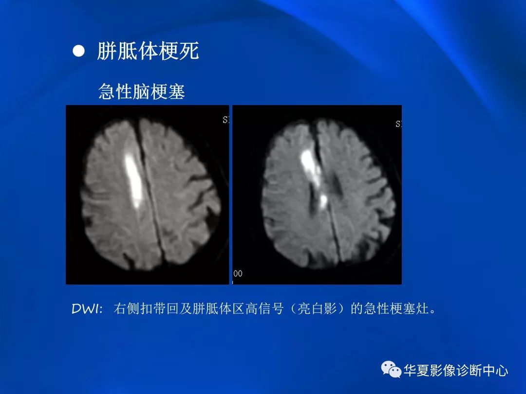 胼胝体病变影像学表现