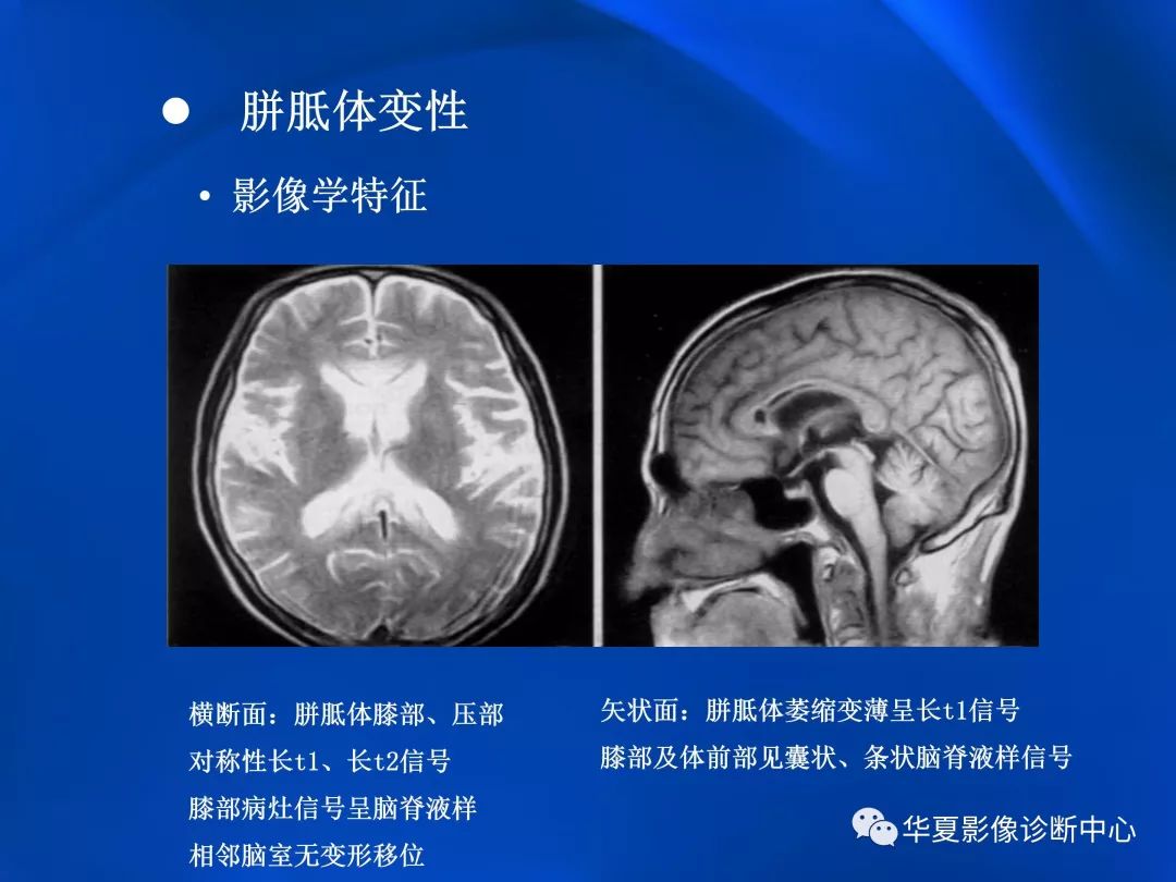 胼胝体病变影像学表现