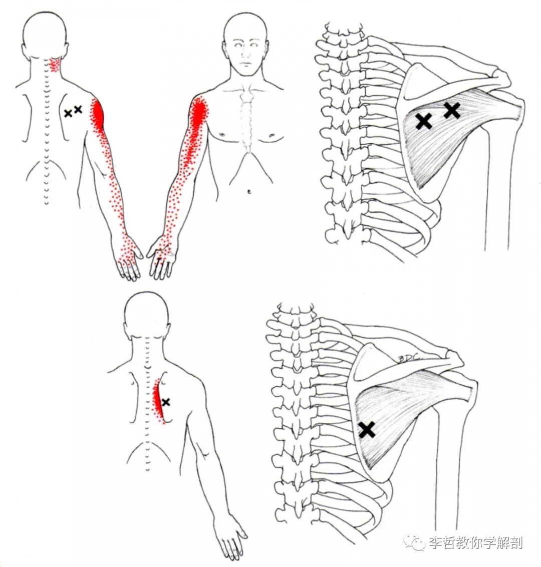 上图是冈上肌触发点常见位置根据图示进行按捏【肩袖肌群】可根据