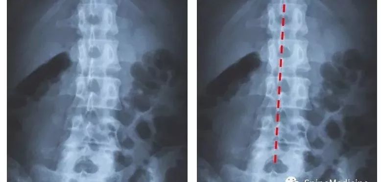 【斯邦解读】腰疼就是腰椎间盘突出症?