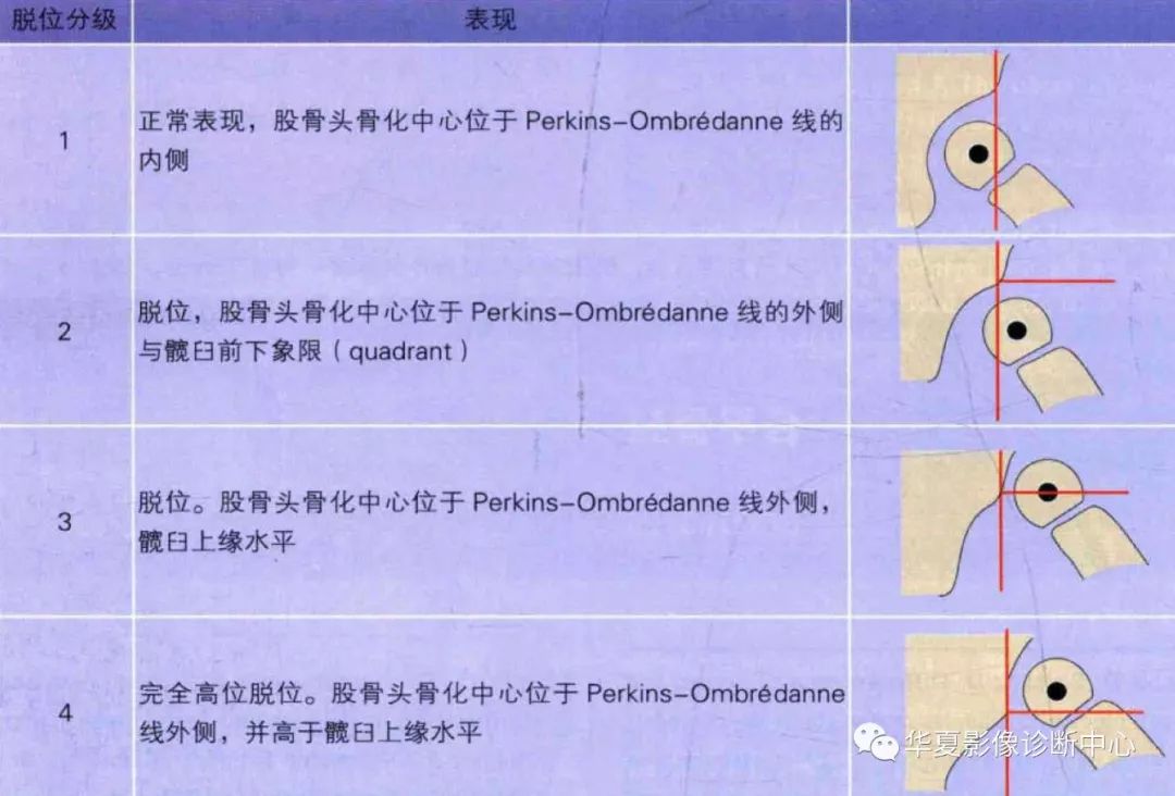 读书笔记14岁儿童髋关节脱位的t00nnis分级