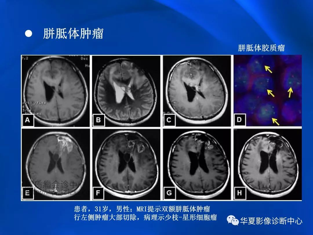 胼胝体病变影像学表现