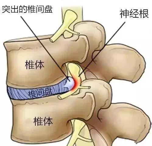 腰椎间盘突出痛