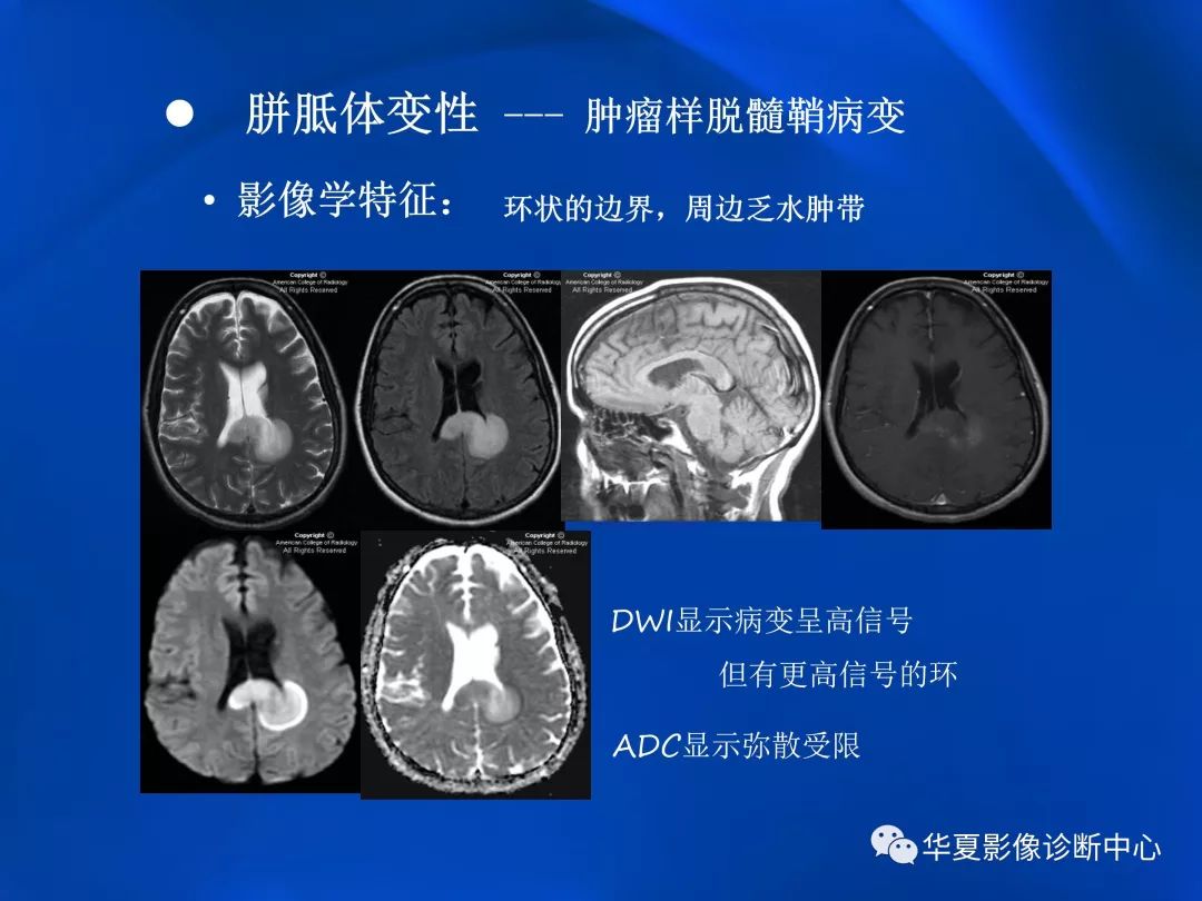 胼胝体病变影像学表现