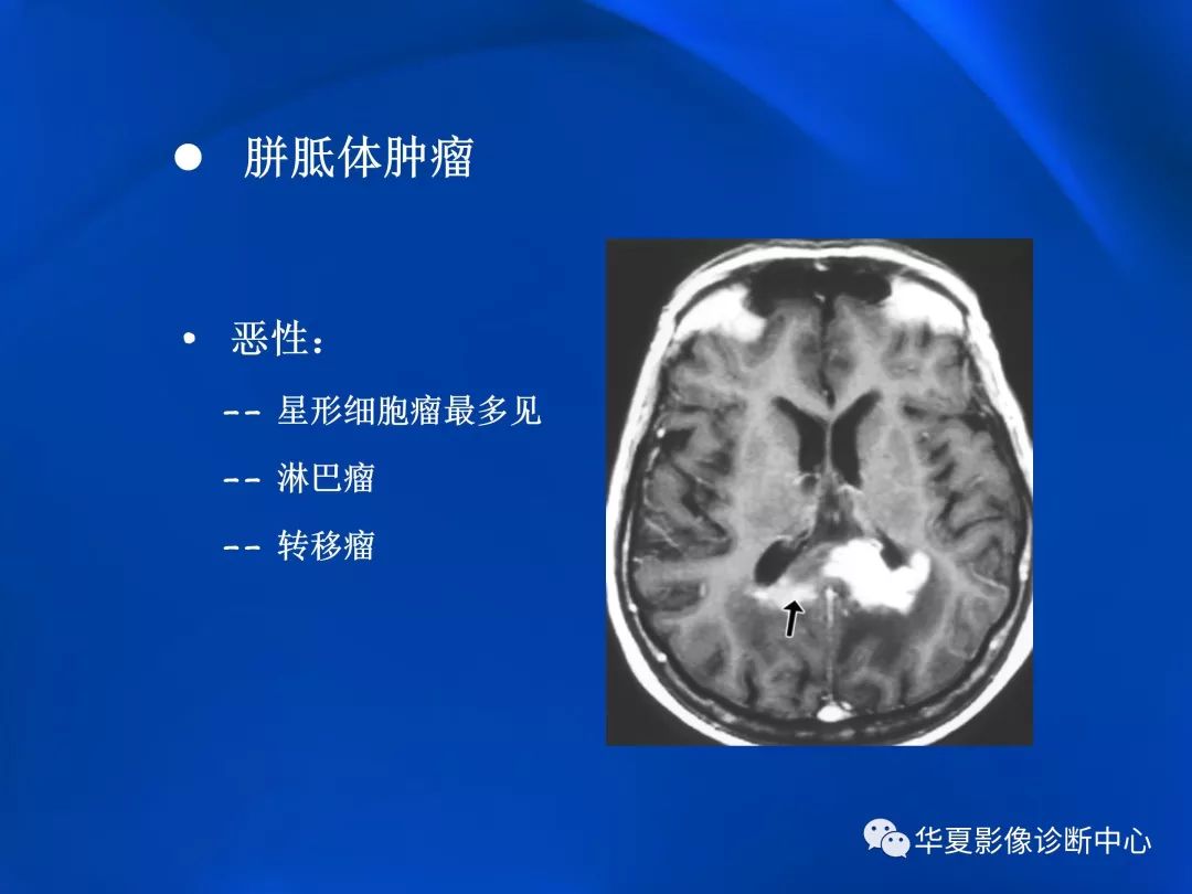 胼胝体病变影像学表现