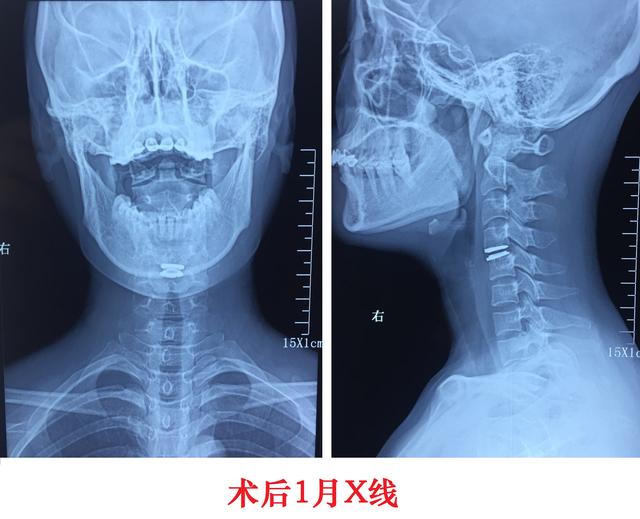 病例分享:神经根型颈椎病的手术治疗_上臂